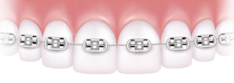 die Illustration einer festen Zahnspange